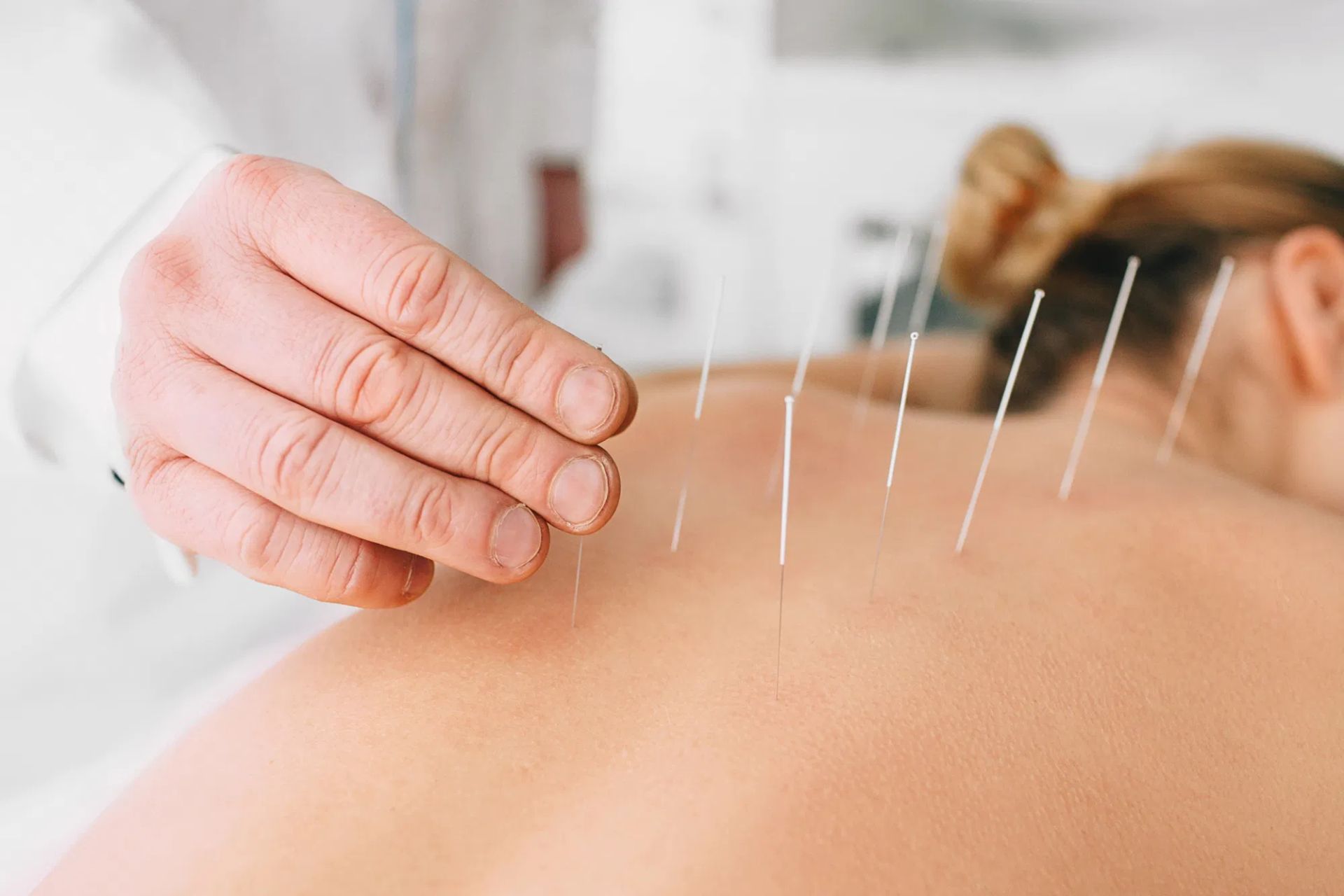 Intramuscular Stimulation  Calgary Acupuncture Clinic