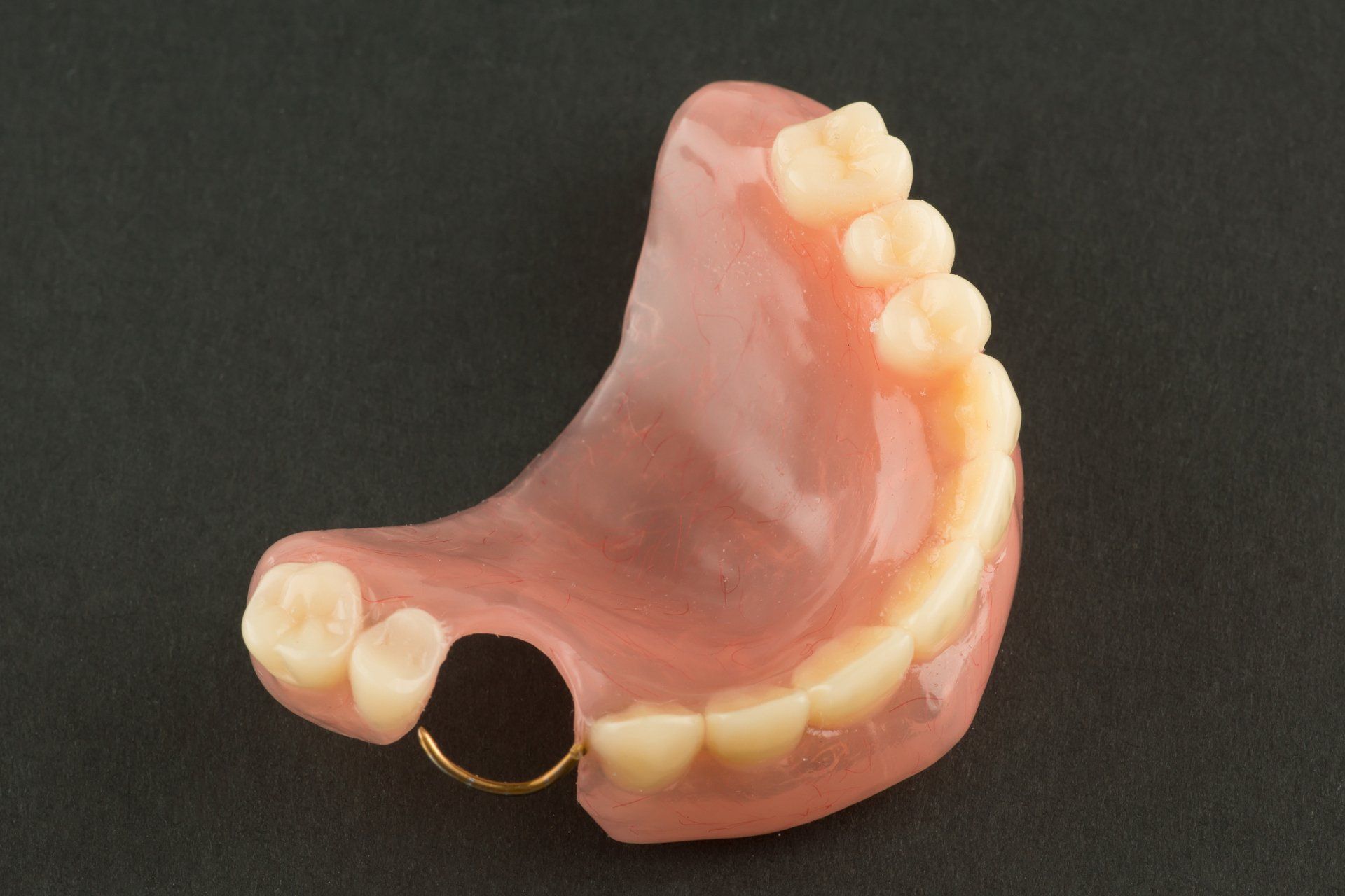 Acrylic Dental Prosthesis With Metal Retaining Elements - Mosman, NSW - Mosman Denture Clinic