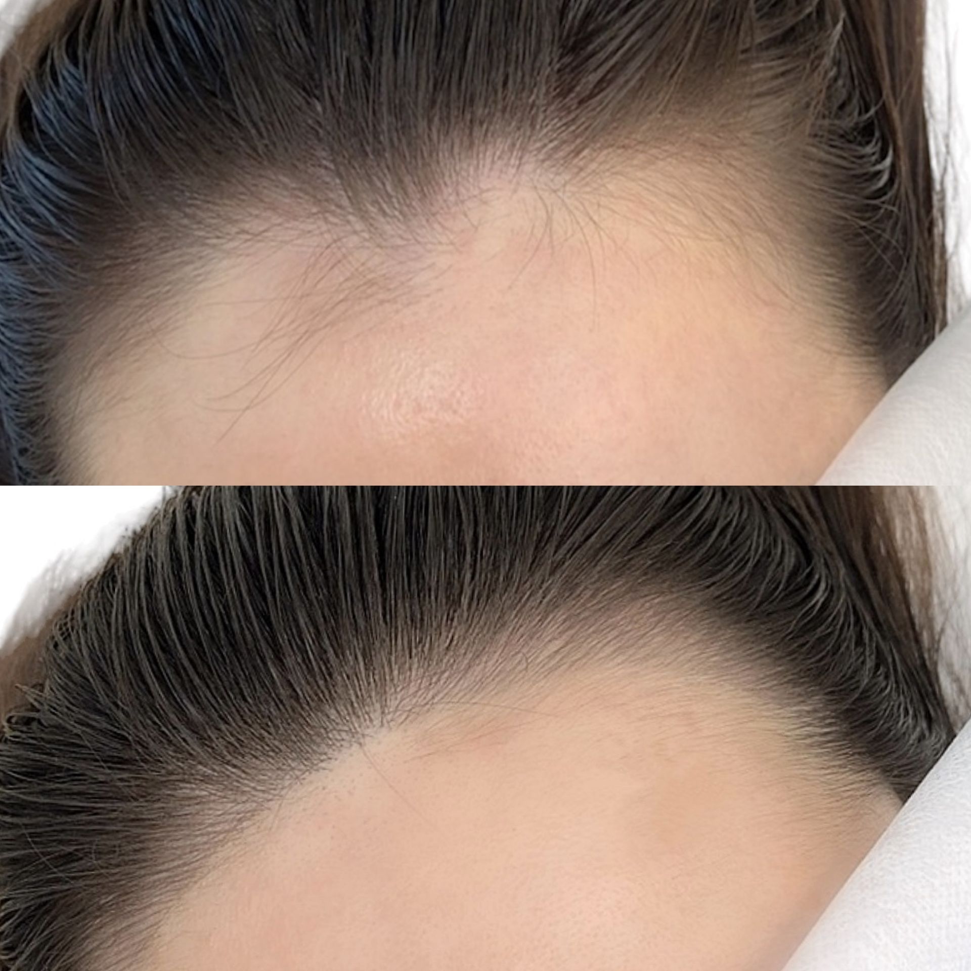 Top: Hair thinning on forehead. Bottom: Hairline after treatment.