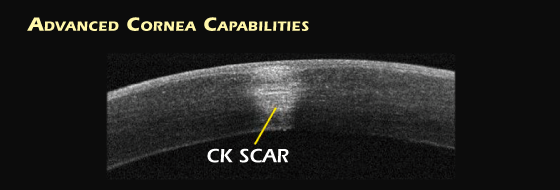 Tomografia a coerenza ottica