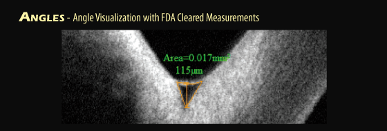 Tomografia a coerenza ottica