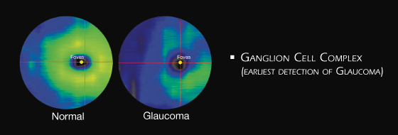 Tomografia a coerenza ottica