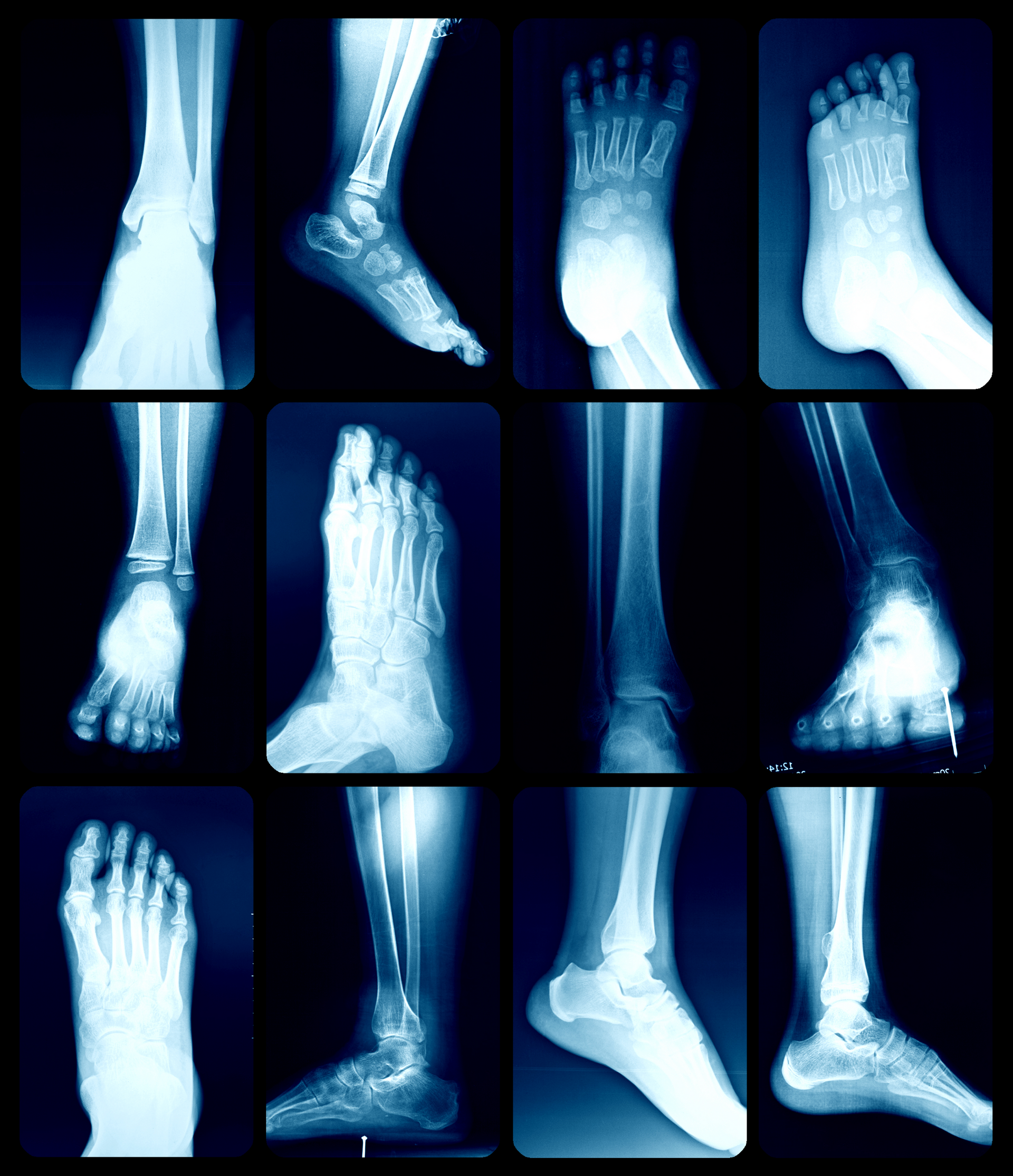 podiatry x-ray of feet for podiatrist