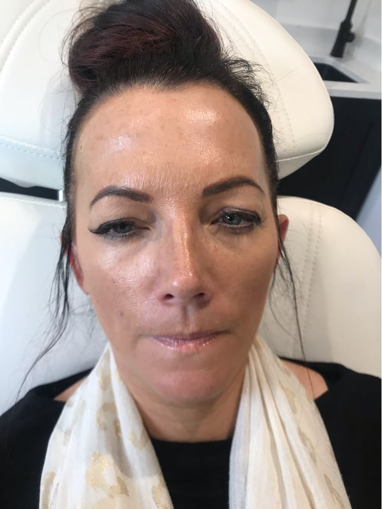Botox frown lines after