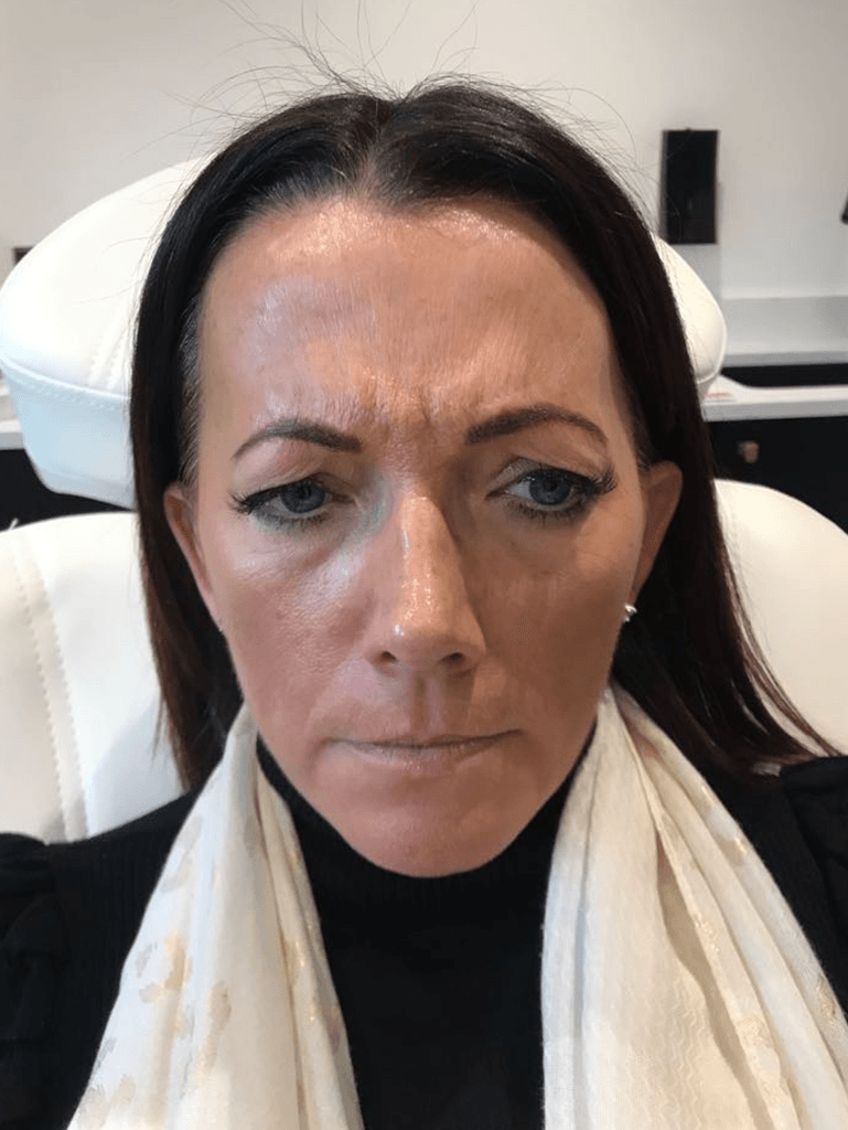 Botox frown lines before