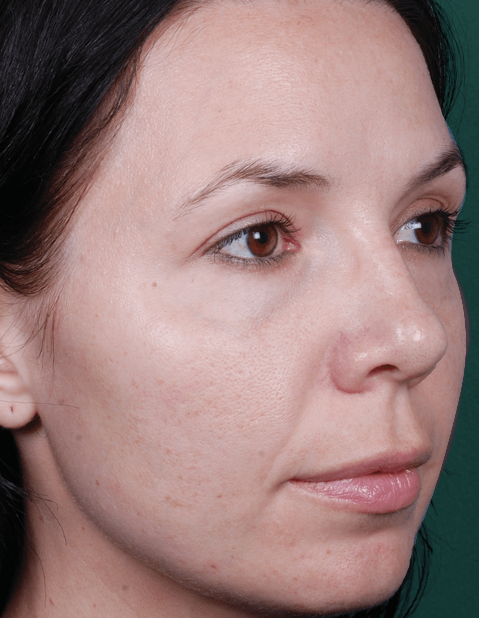 Chemical peels after