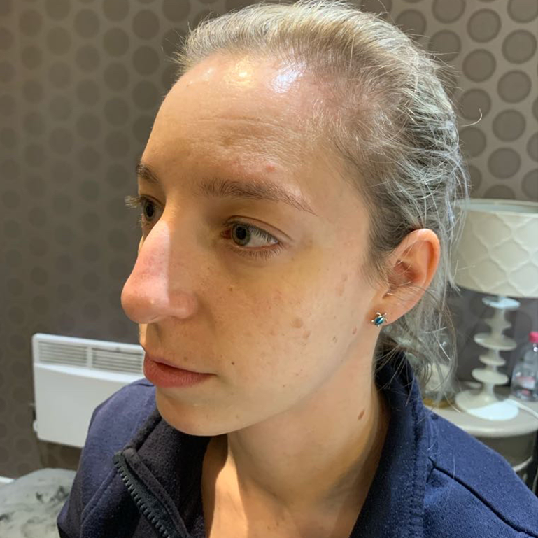 Scar treatment using microneedling-after