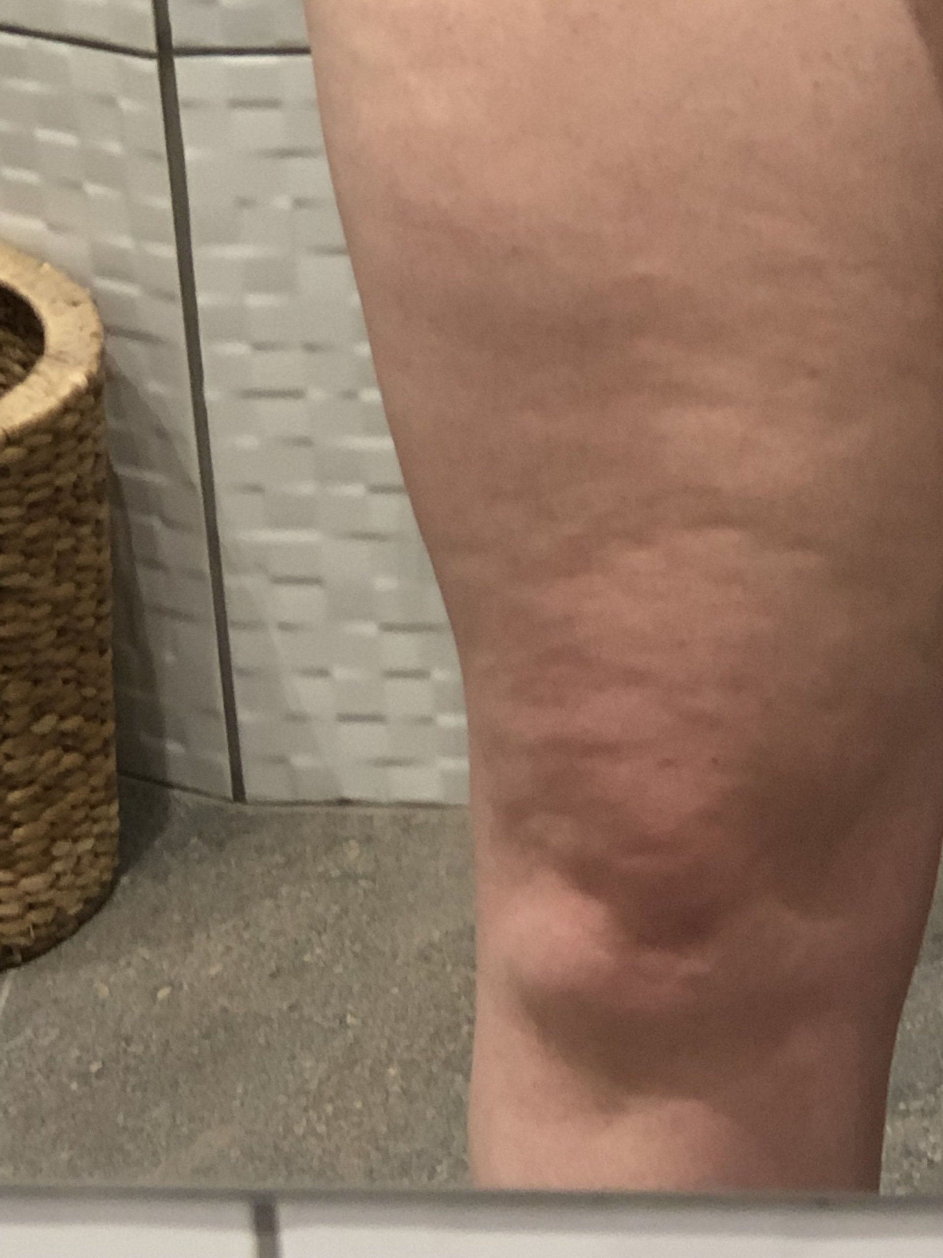 Skinade targeted solutions cellulite before