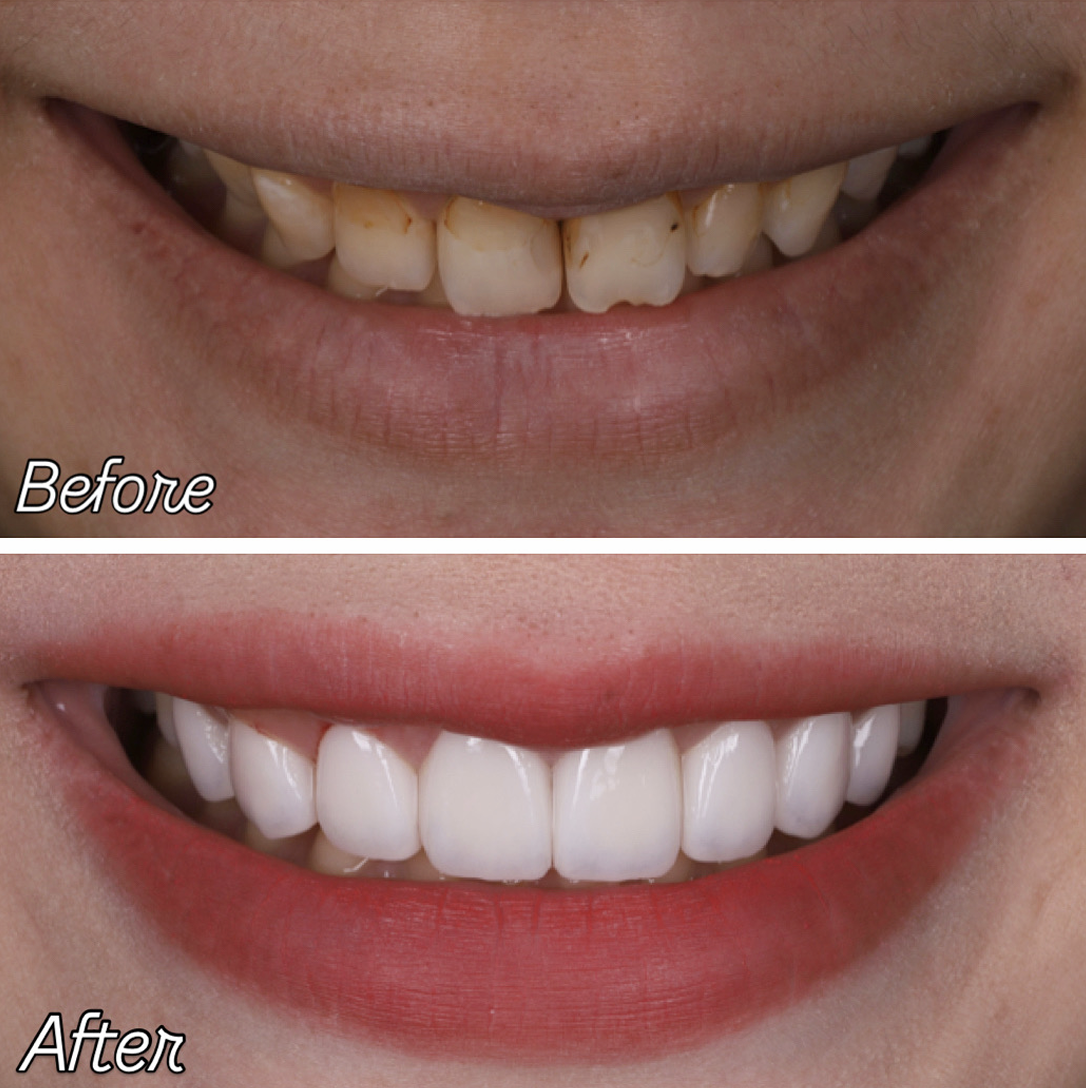 陶瓷貼片的基本認知：優缺點與磨牙的必要性｜黃琮勛醫師 美容牙科｜頂級陶瓷貼片｜微笑設計