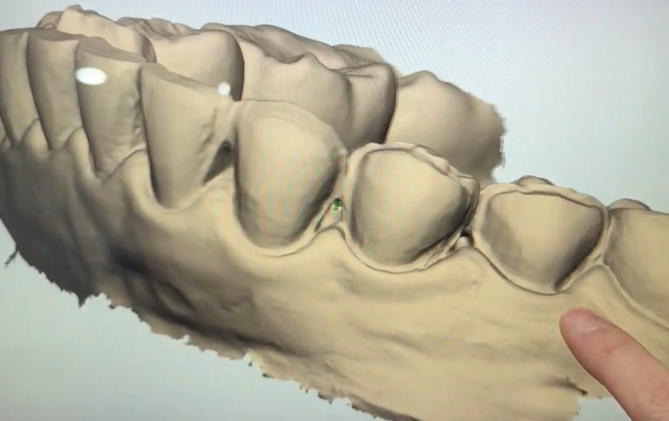 陶瓷貼片的基本認知：優缺點與磨牙的必要性｜黃琮勛醫師 美容牙科｜頂級陶瓷貼片｜微笑設計