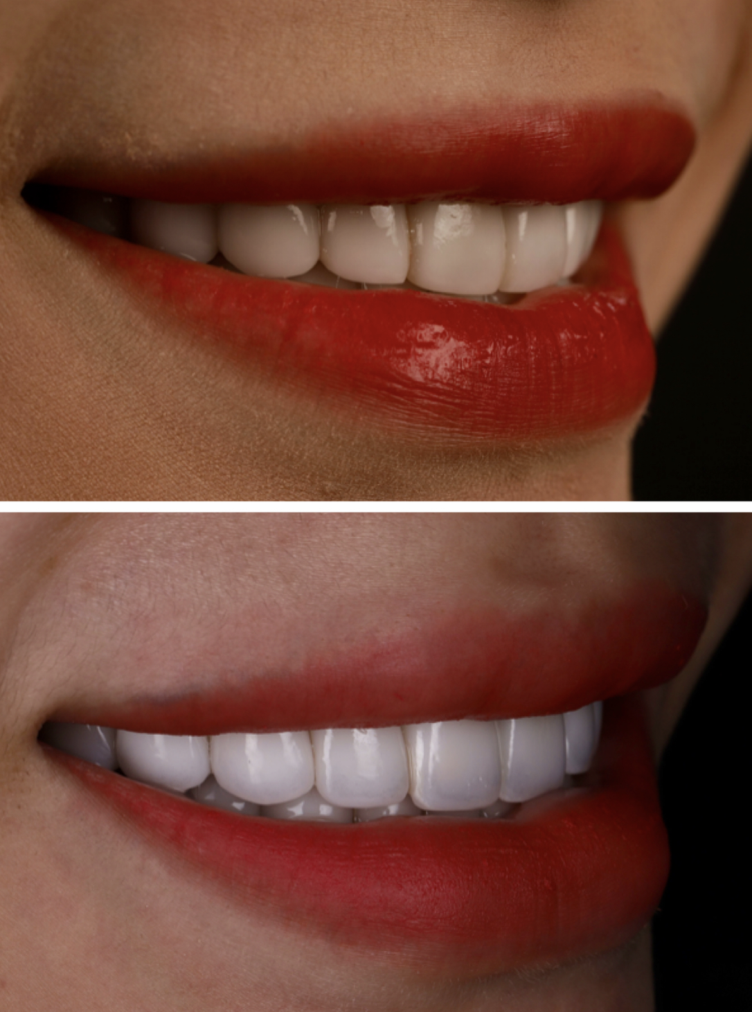 黃琮勛醫師 美容牙科|頂級陶瓷貼片|微笑設計陶瓷貼片進階問答:價格、範圍與美學考量