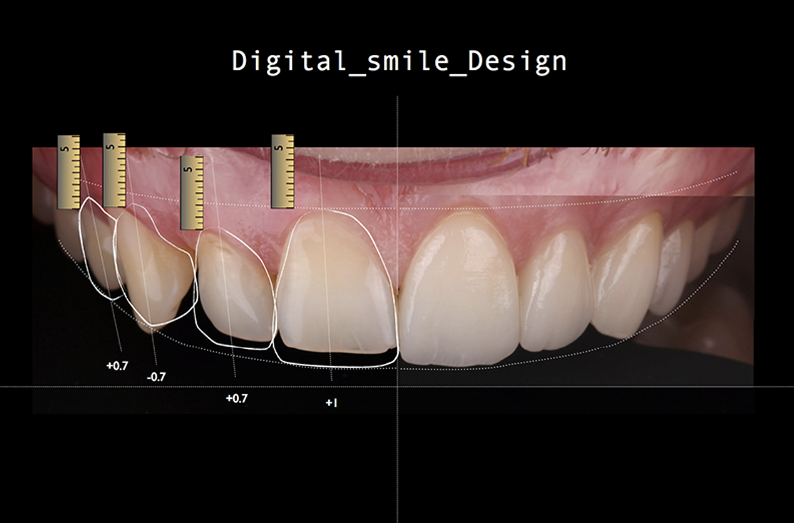 黃琮勛醫師 美容牙科|頂級陶瓷貼片|微笑設計陶瓷貼片進階問答:價格、範圍與美學考量