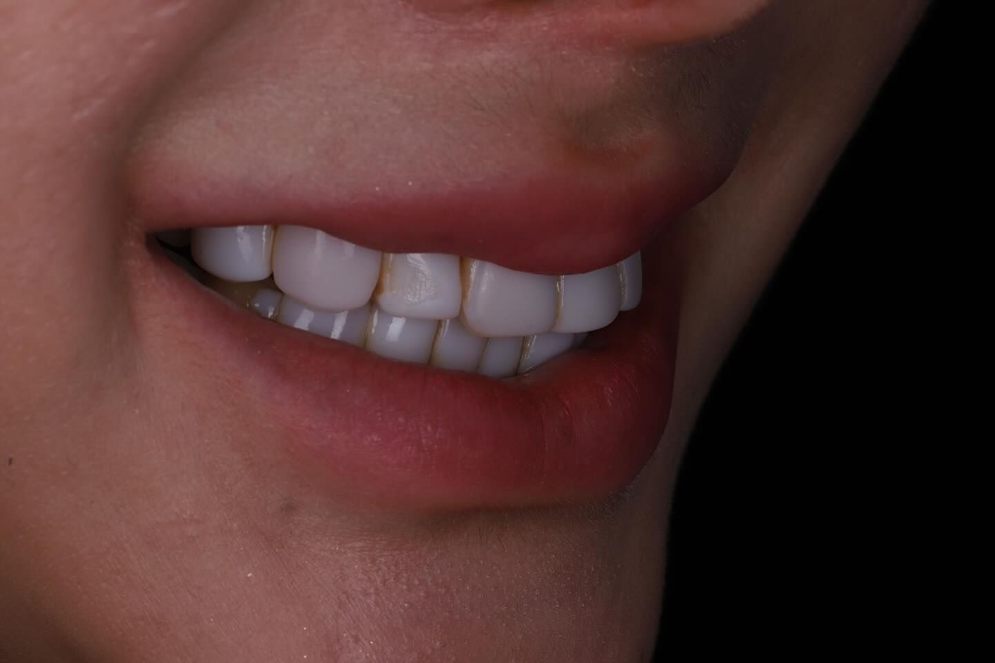 黃琮勛醫師 美容牙科｜頂級陶瓷貼片｜微笑設計從「齒」閃耀日系透明感 告別樹脂貼片｜混血美姬 阿厚綾