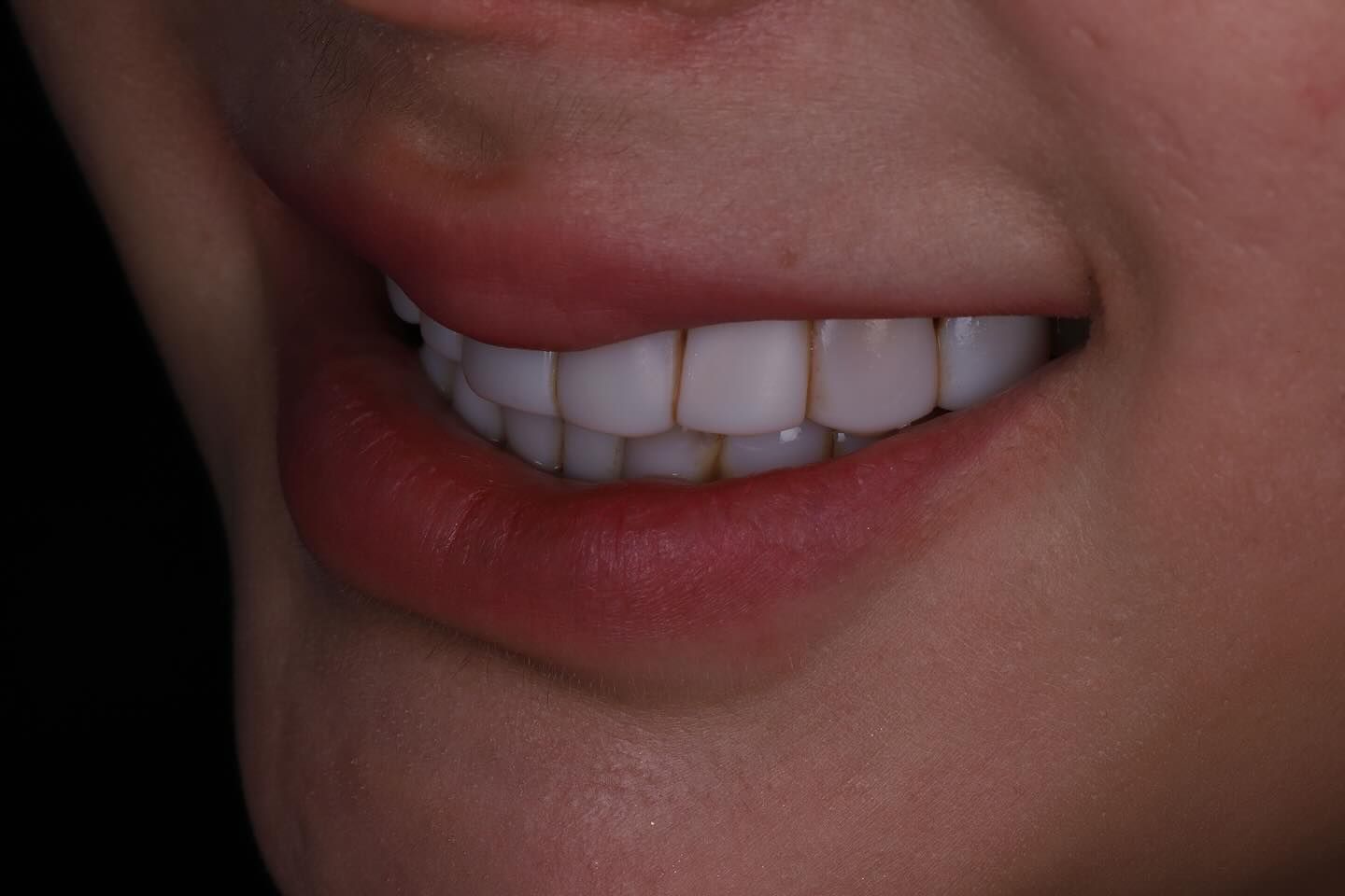 黃琮勛醫師 美容牙科｜頂級陶瓷貼片｜微笑設計從「齒」閃耀日系透明感 告別樹脂貼片｜混血美姬 阿厚綾