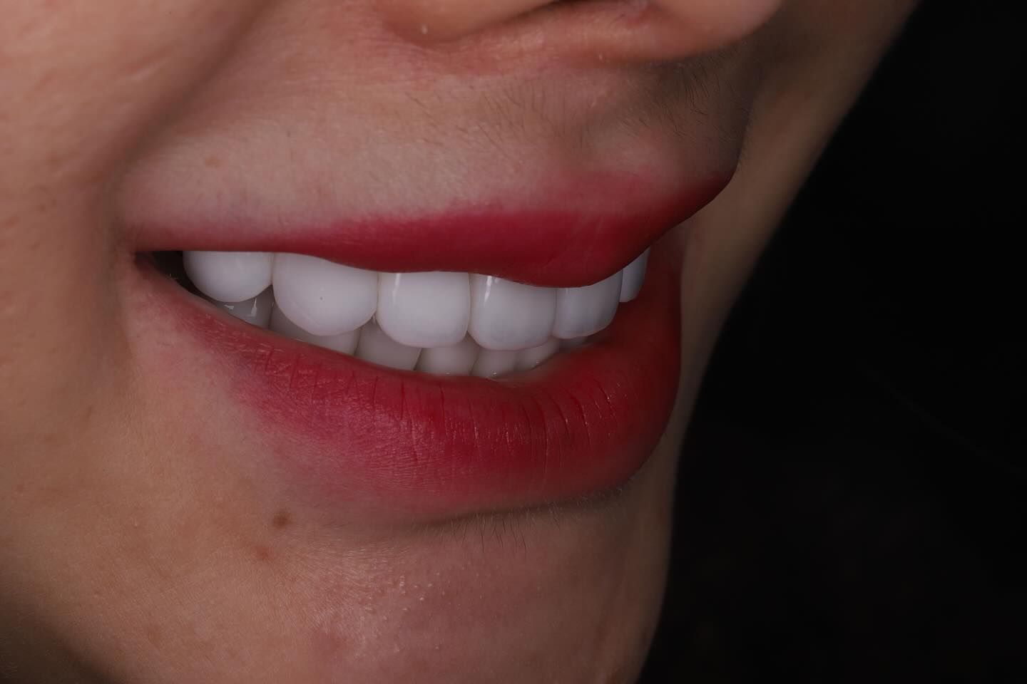 黃琮勛醫師 美容牙科｜頂級陶瓷貼片｜微笑設計從「齒」閃耀日系透明感 告別樹脂貼片｜混血美姬 阿厚綾