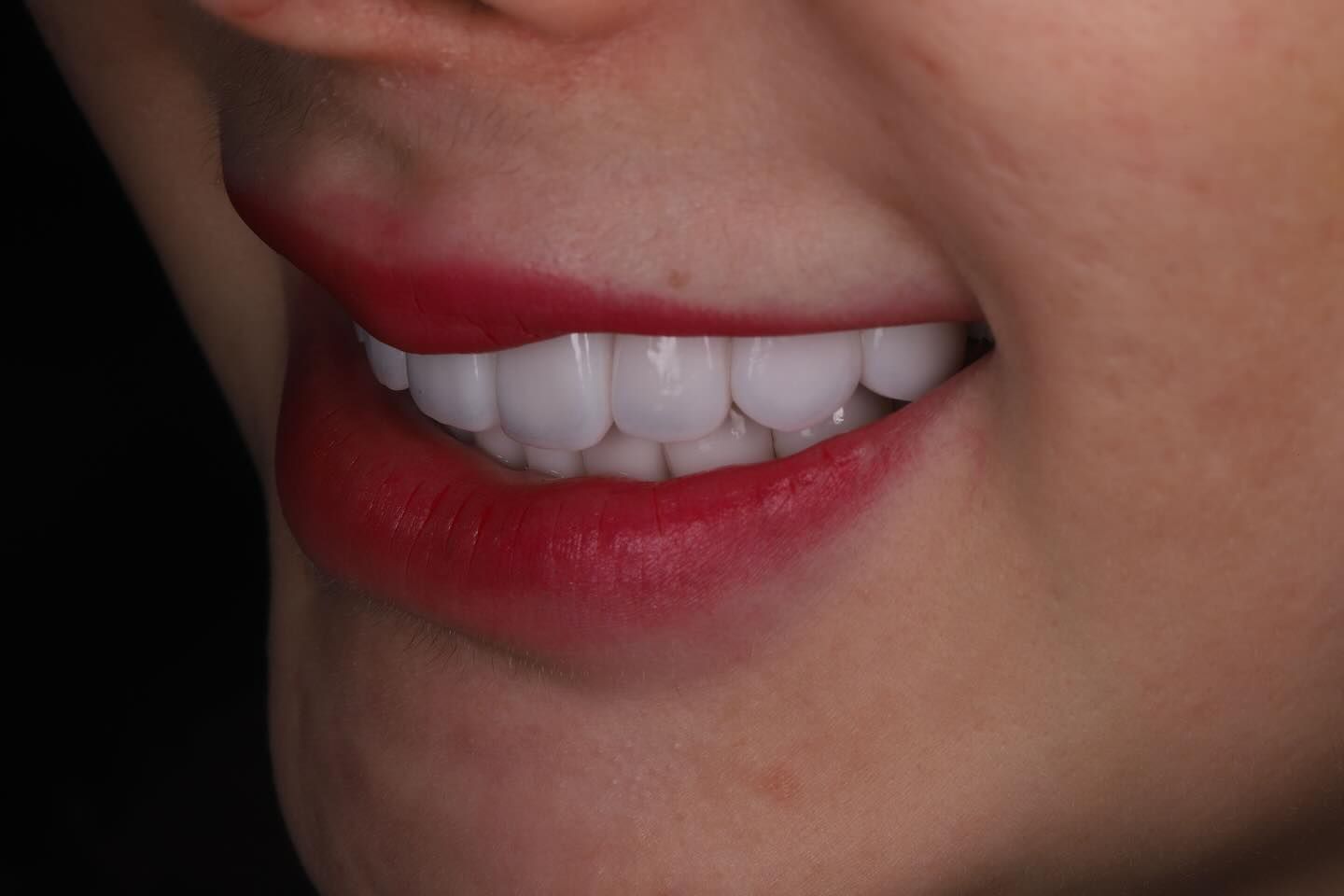 黃琮勛醫師 美容牙科｜頂級陶瓷貼片｜微笑設計從「齒」閃耀日系透明感 告別樹脂貼片｜混血美姬 阿厚綾