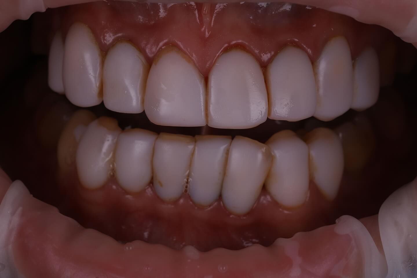 黃琮勛醫師 美容牙科｜頂級陶瓷貼片｜微笑設計從「齒」閃耀日系透明感 告別樹脂貼片｜混血美姬 阿厚綾