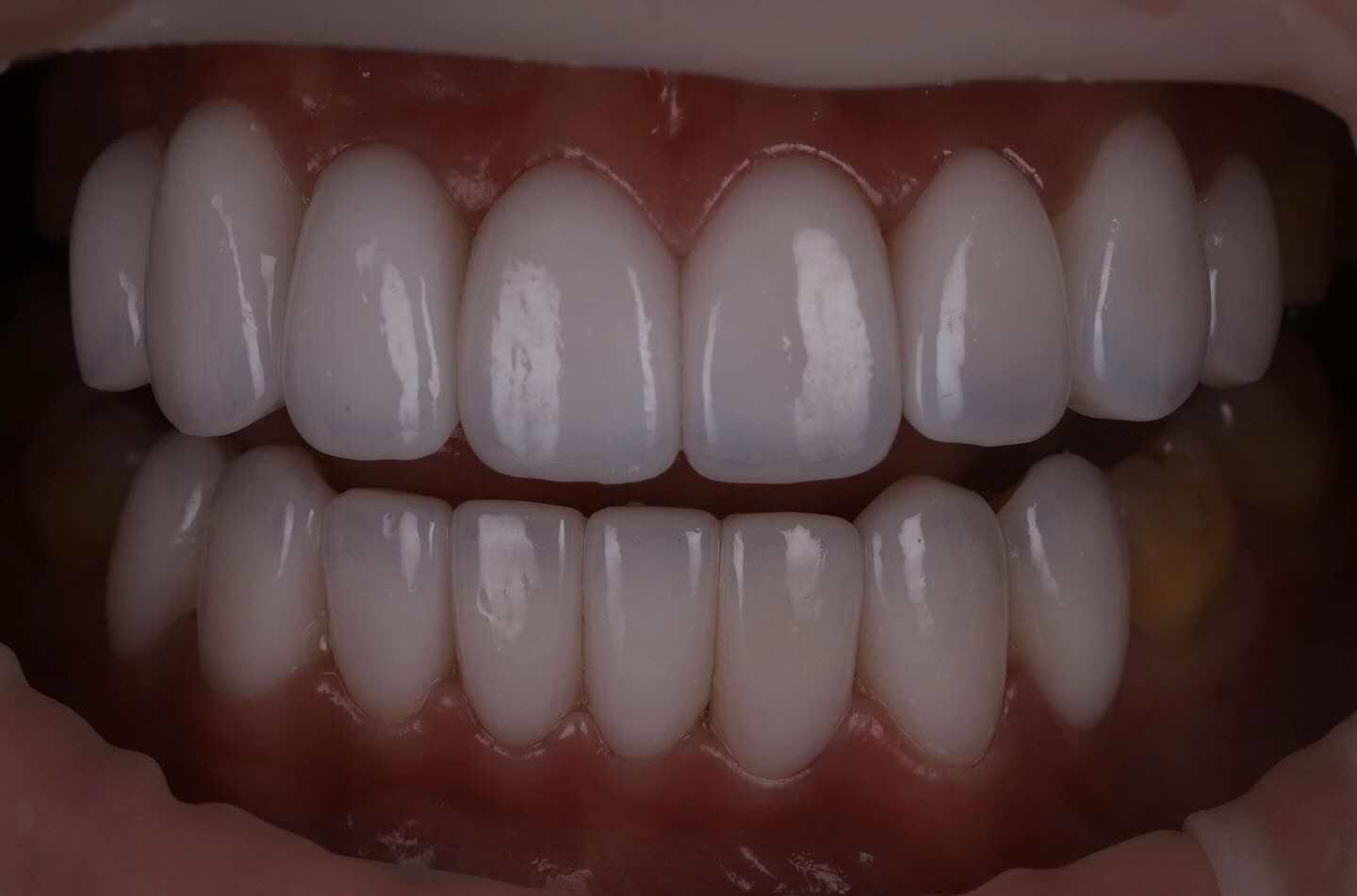 黃琮勛醫師 美容牙科｜頂級陶瓷貼片｜微笑設計從「齒」閃耀日系透明感 告別樹脂貼片｜混血美姬 阿厚綾