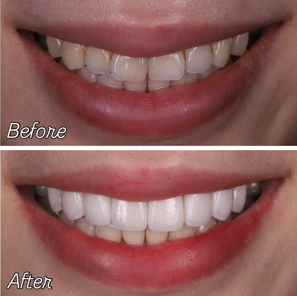 找回自信笑容的另一種選擇｜Ms. Chang｜黃琮勛醫師 美容牙科｜頂級陶瓷貼片｜微笑設計