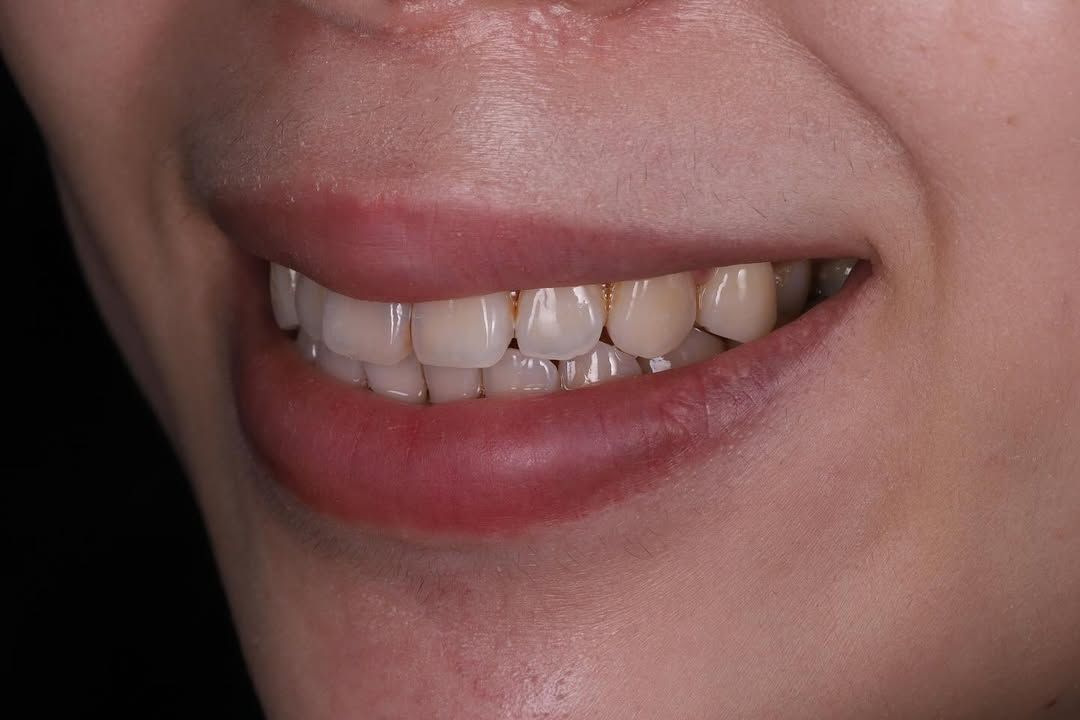 找回自信笑容的另一種選擇｜Ms. Chang｜黃琮勛醫師 美容牙科｜頂級陶瓷貼片｜微笑設計