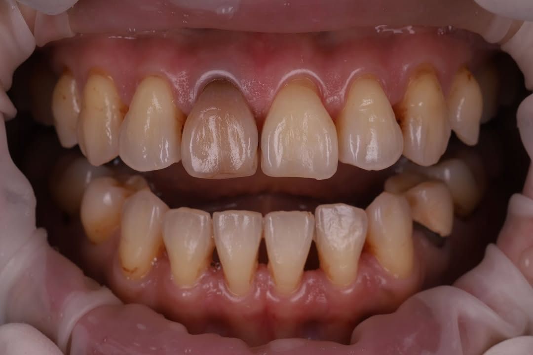 帶著自然笑容回家過年｜Ms. Chen｜黃琮勛醫師 美容牙科｜頂級陶瓷貼片｜微笑設計