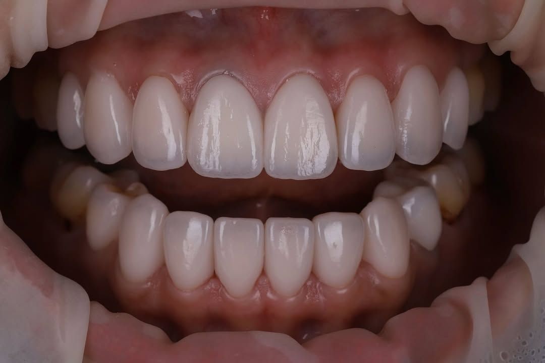 帶著自然笑容回家過年｜Ms. Chen｜黃琮勛醫師 美容牙科｜頂級陶瓷貼片｜微笑設計