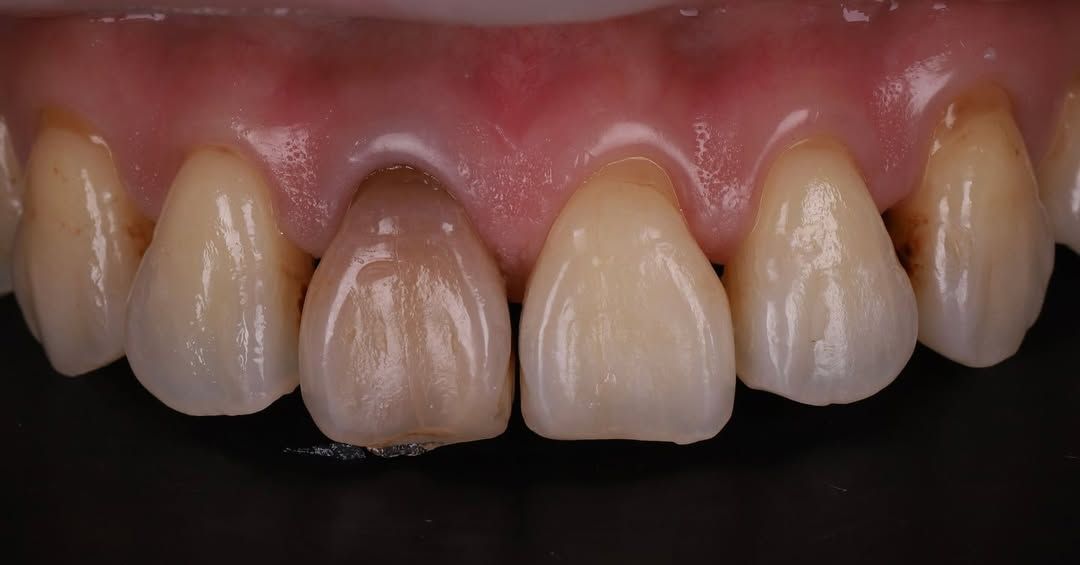 帶著自然笑容回家過年｜Ms. Chen｜黃琮勛醫師 美容牙科｜頂級陶瓷貼片｜微笑設計