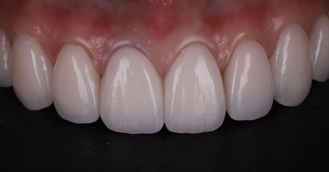 帶著自然笑容回家過年｜Ms. Chen｜黃琮勛醫師 美容牙科｜頂級陶瓷貼片｜微笑設計