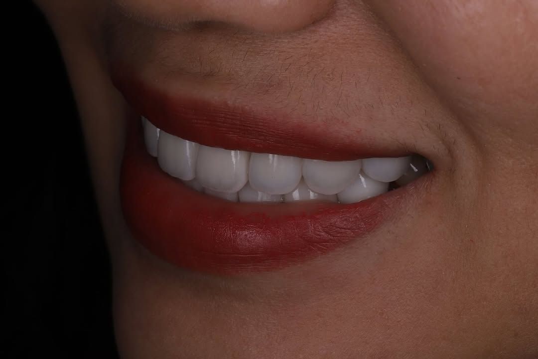 帶著自然笑容回家過年｜Ms. Chen｜黃琮勛醫師 美容牙科｜頂級陶瓷貼片｜微笑設計