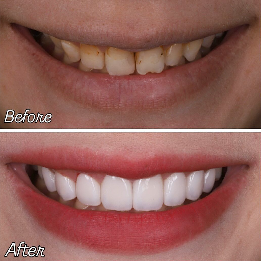 美麗笑顏是婚禮的最後拼圖｜準新娘 Ms. Lee｜黃琮勛醫師 美容牙科｜頂級陶瓷貼片｜微笑設計