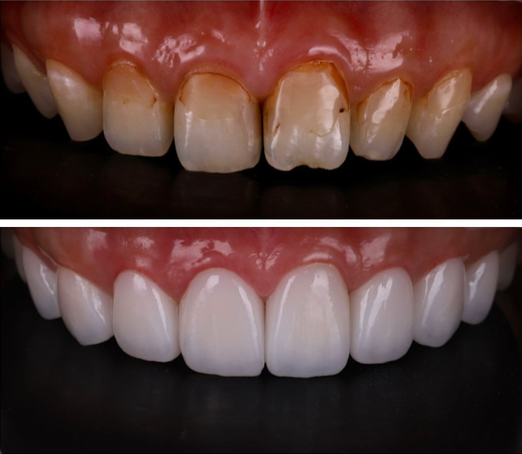 美麗笑顏是婚禮的最後拼圖｜準新娘 Ms. Lee｜黃琮勛醫師 美容牙科｜頂級陶瓷貼片｜微笑設計