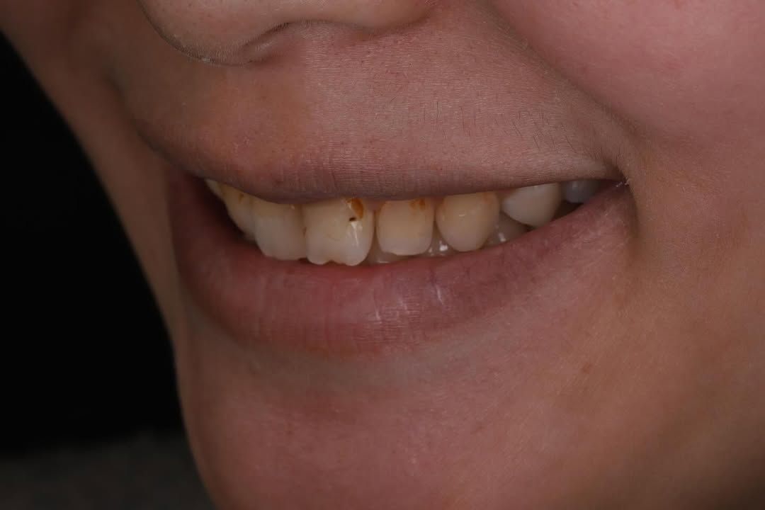 美麗笑顏是婚禮的最後拼圖｜準新娘 Ms. Lee｜黃琮勛醫師 美容牙科｜頂級陶瓷貼片｜微笑設計