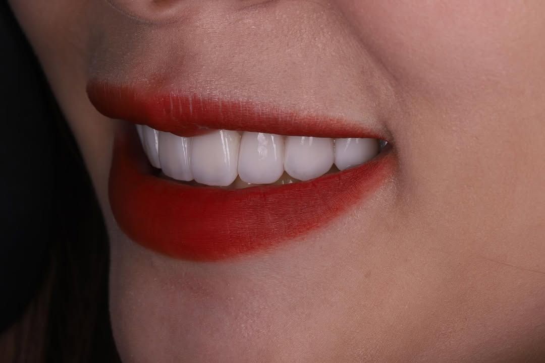 美麗笑顏是婚禮的最後拼圖｜準新娘 Ms. Lee｜黃琮勛醫師 美容牙科｜頂級陶瓷貼片｜微笑設計