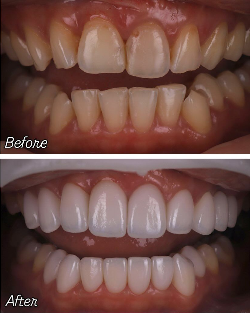 煥發豐盈光彩的燦爛笑顏｜Ms. Liu｜黃琮勛醫師 美容牙科｜頂級陶瓷貼片｜微笑設計