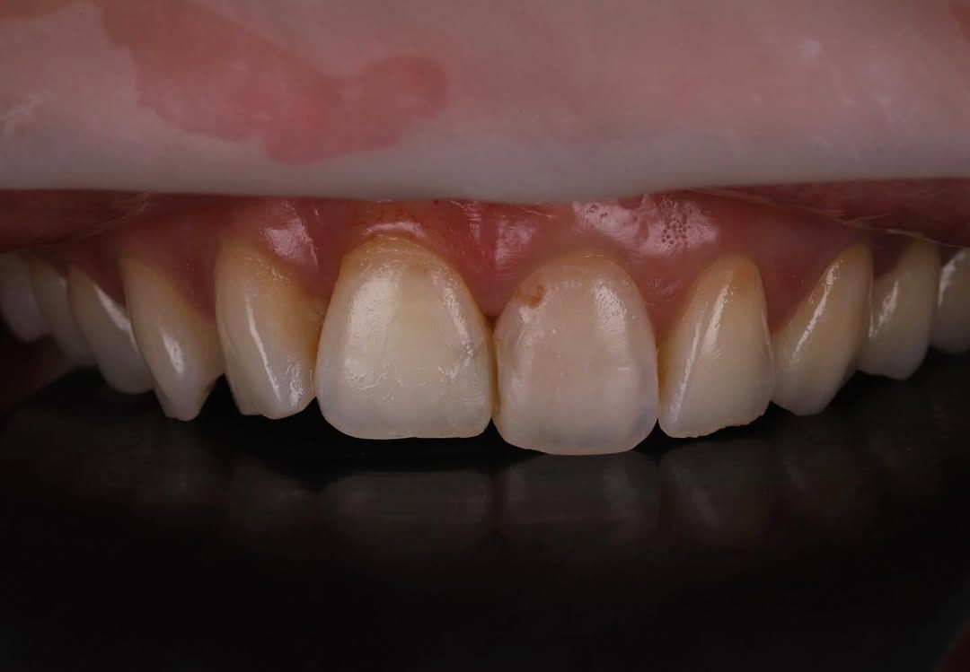 煥發豐盈光彩的燦爛笑顏｜Ms. Liu｜黃琮勛醫師 美容牙科｜頂級陶瓷貼片｜微笑設計