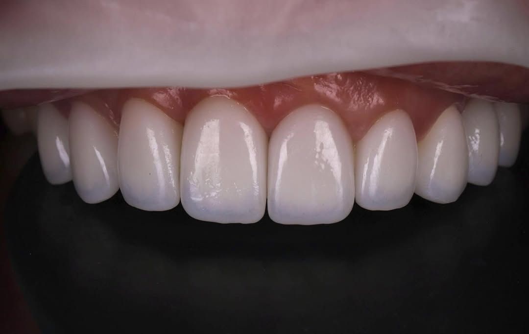 煥發豐盈光彩的燦爛笑顏｜Ms. Liu｜黃琮勛醫師 美容牙科｜頂級陶瓷貼片｜微笑設計