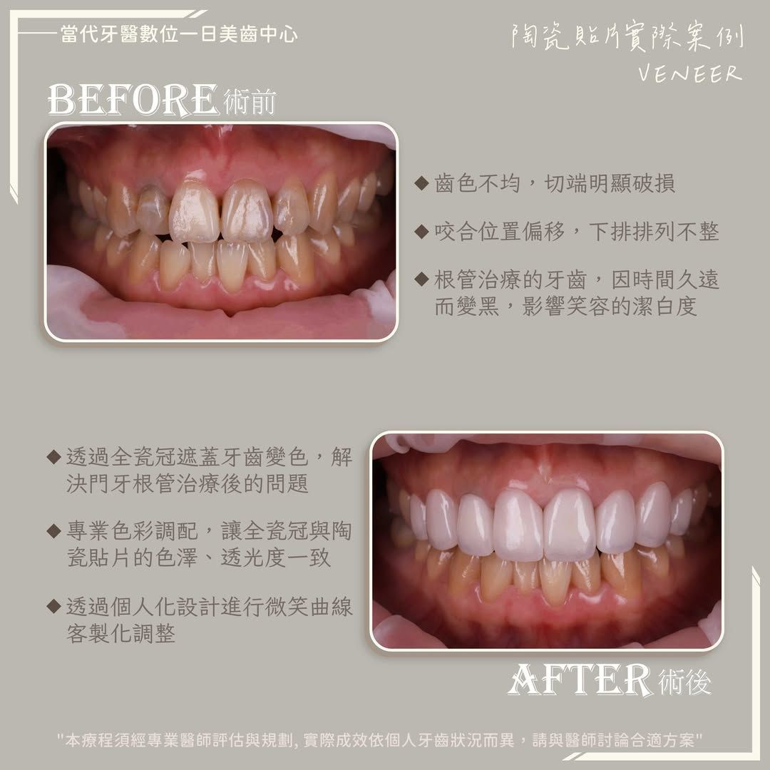 黃琮勛醫師 美容牙科｜頂級陶瓷貼片｜微笑設計自信笑容是婚禮的最美妝容｜最美新娘 Yi Jie