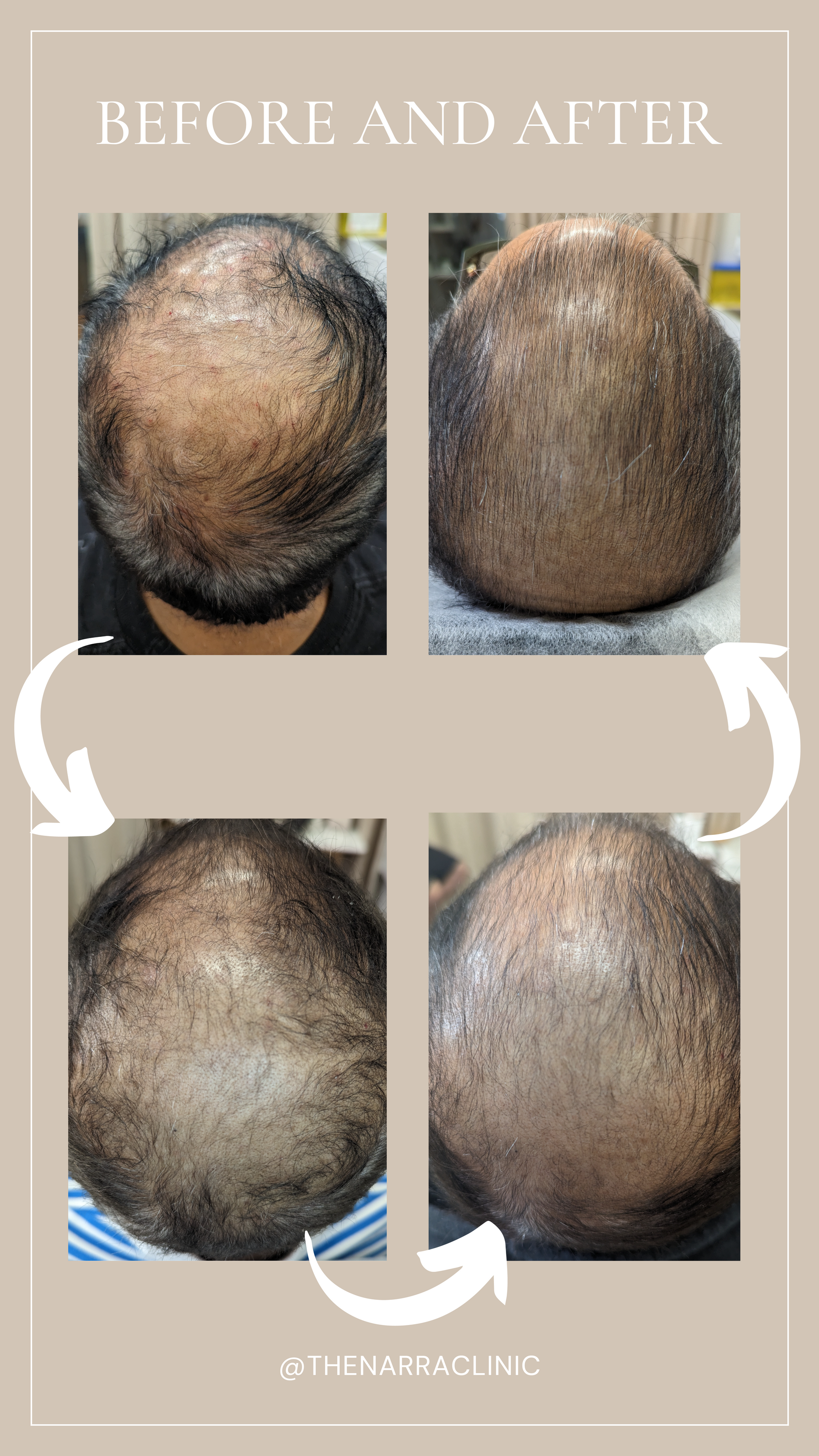 A man 's head is shown before and after a hair transplant.