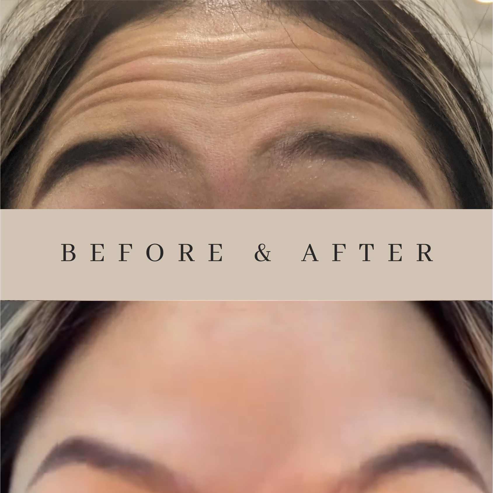 A woman 's forehead before and after botox injections.
