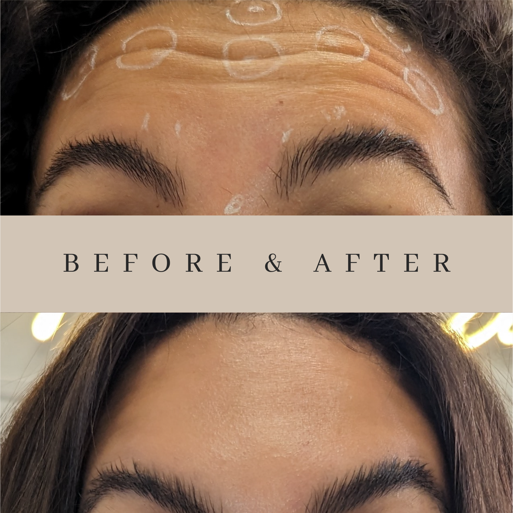 A before and after photo of a woman 's forehead