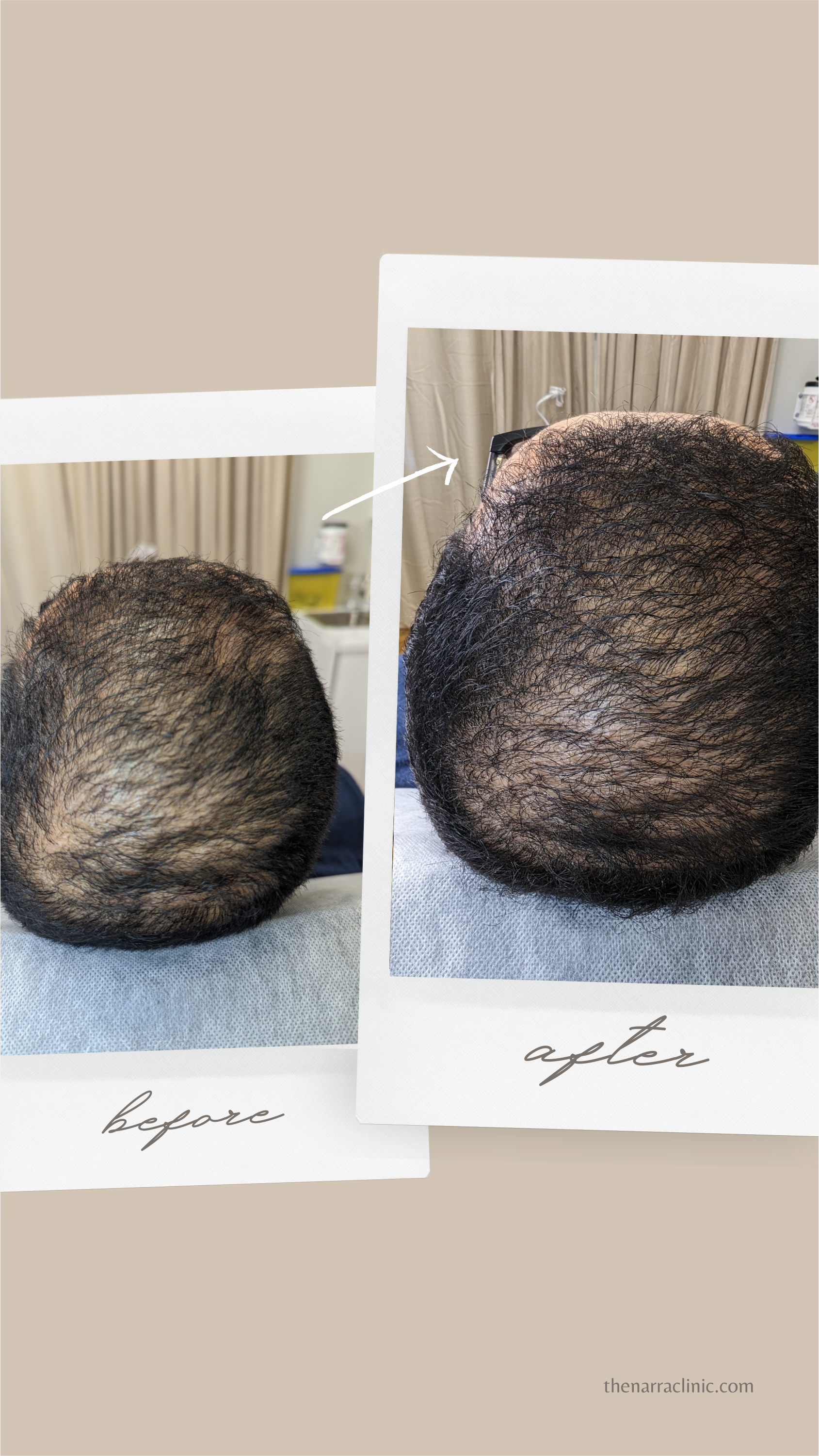 A before and after picture of a person 's head with hair loss.