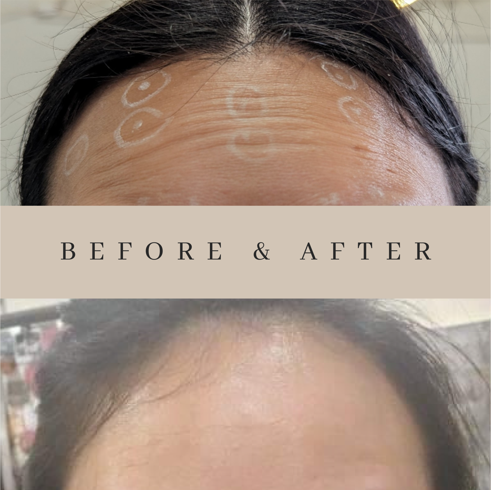 A before and after photo of a woman 's forehead