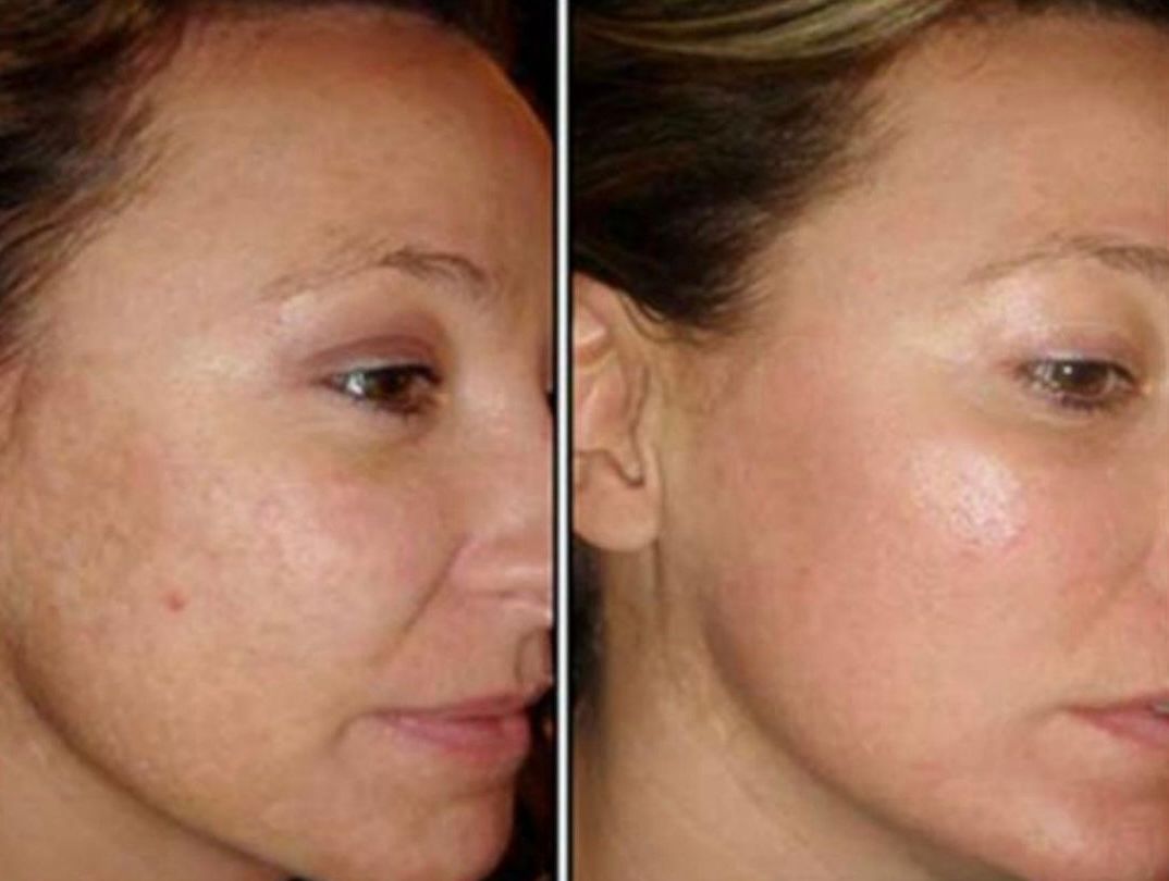 A before and after photo of a woman 's face