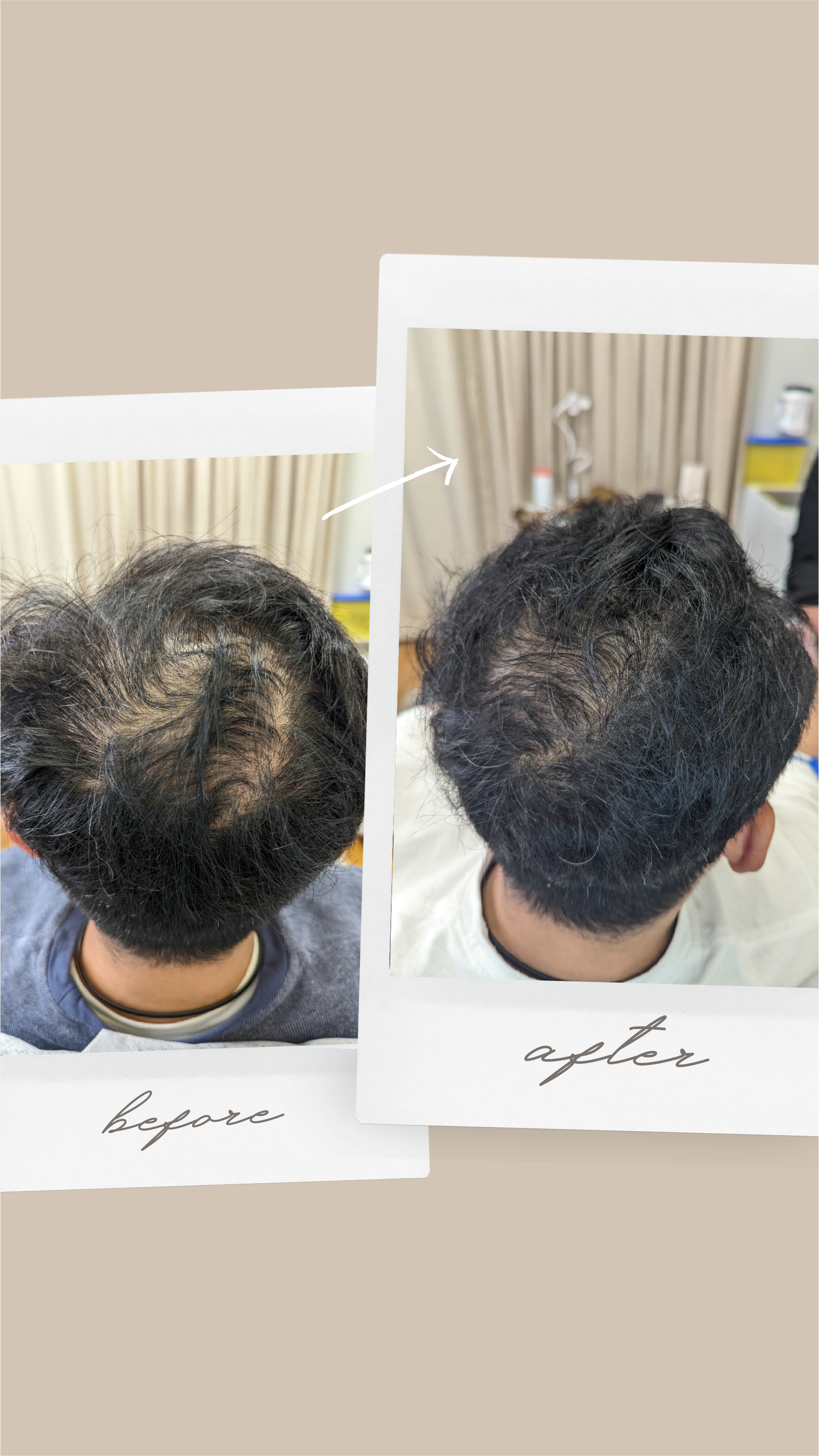 A before and after photo of a man 's hair growth.