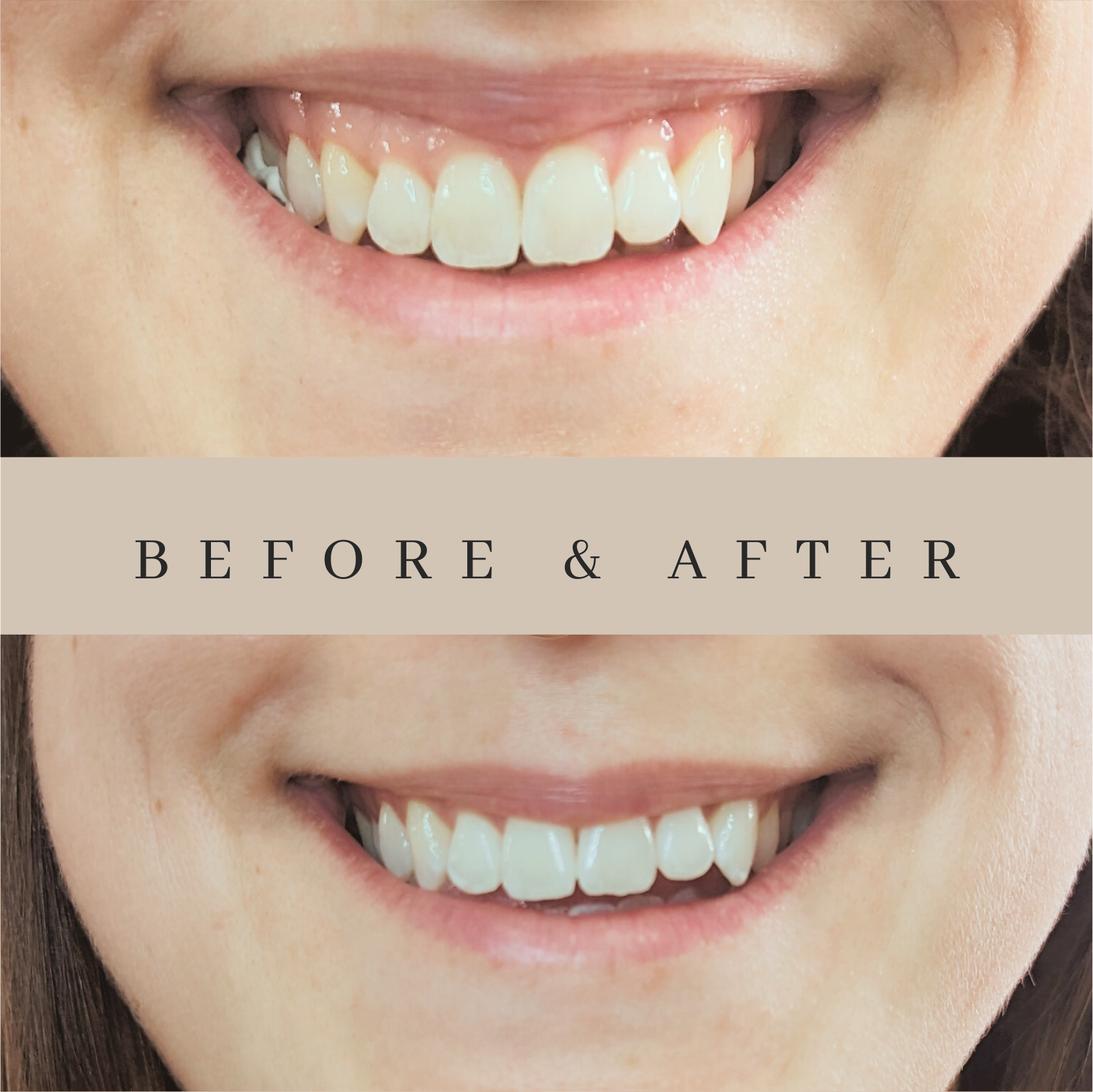 A before and after photo of a woman 's teeth