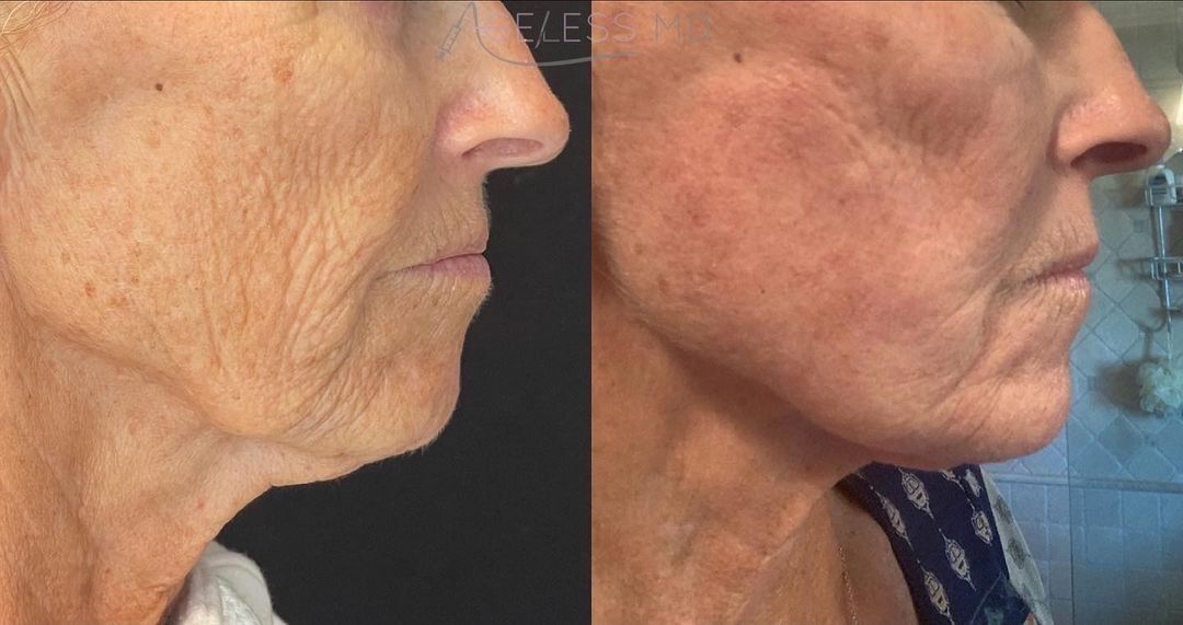 A before and after photo of a woman 's face and neck.