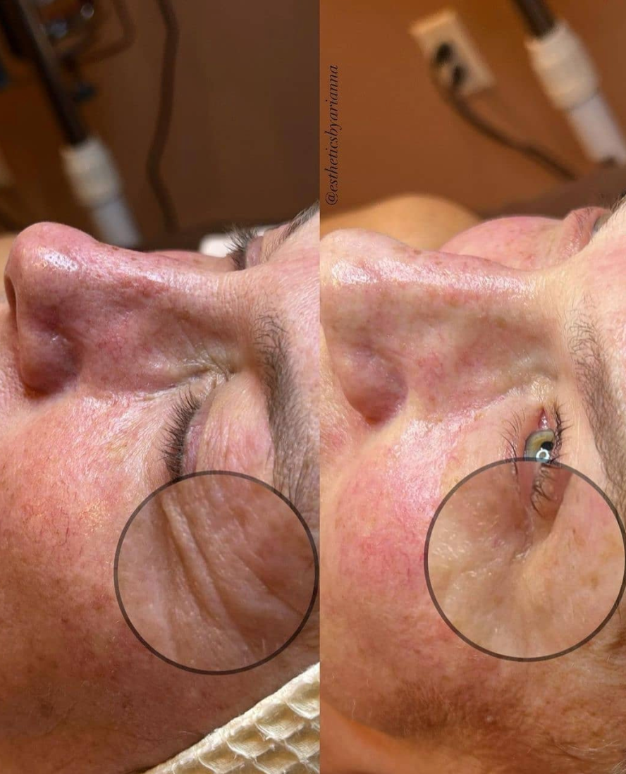A woman 's face is shown before and after a treatment.