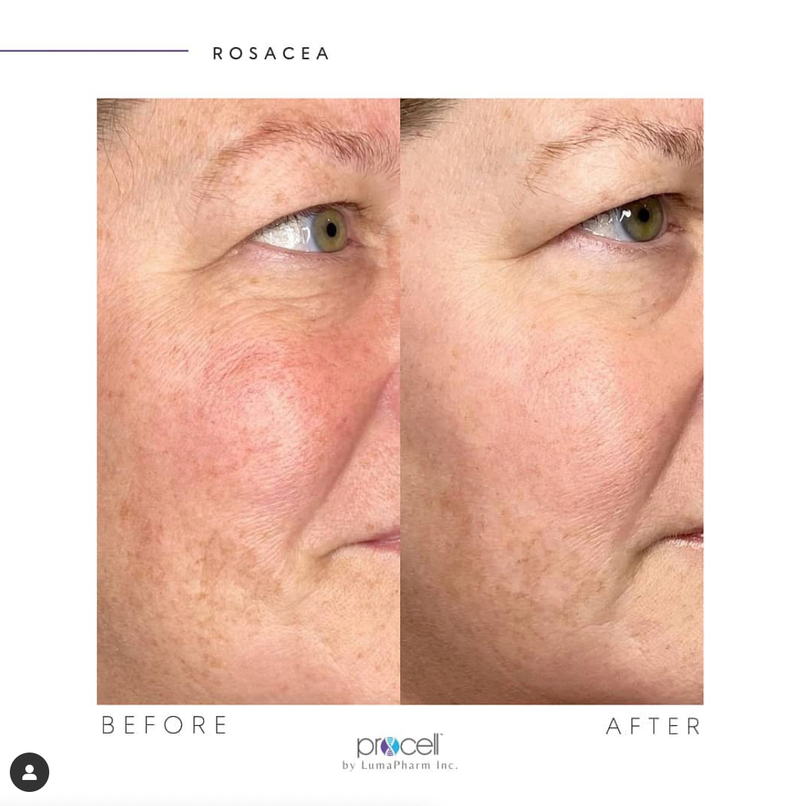 A before and after photo of a woman 's face with red spots.