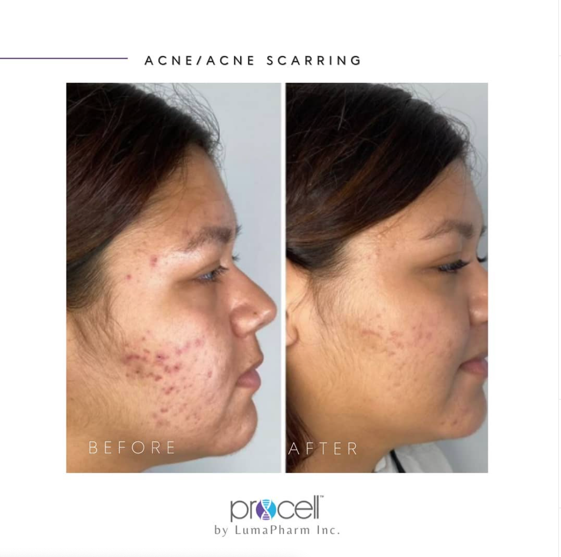A before and after photo of acne scarring on a woman 's face