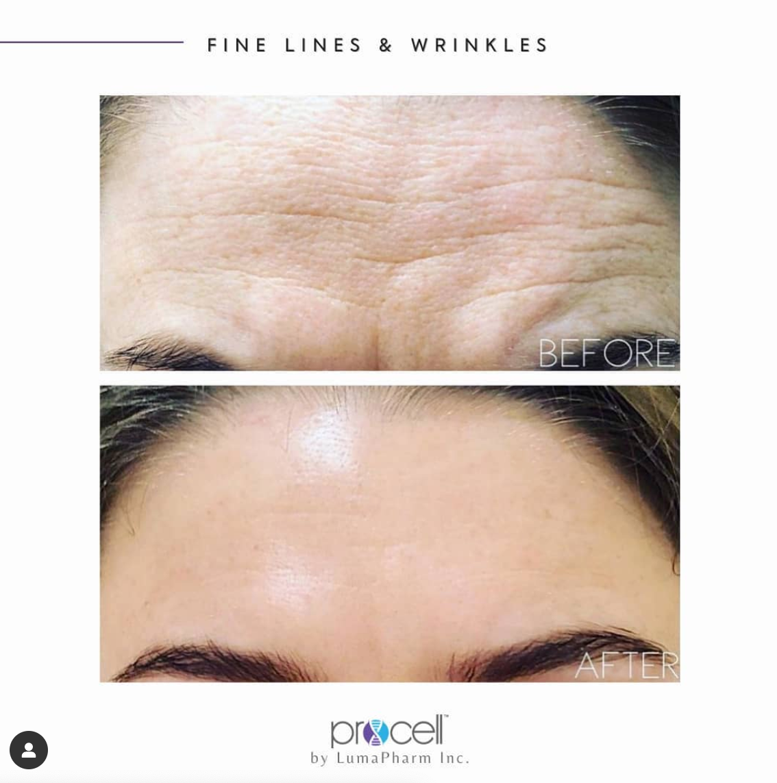A before and after picture of a woman 's forehead with fine lines and wrinkles.